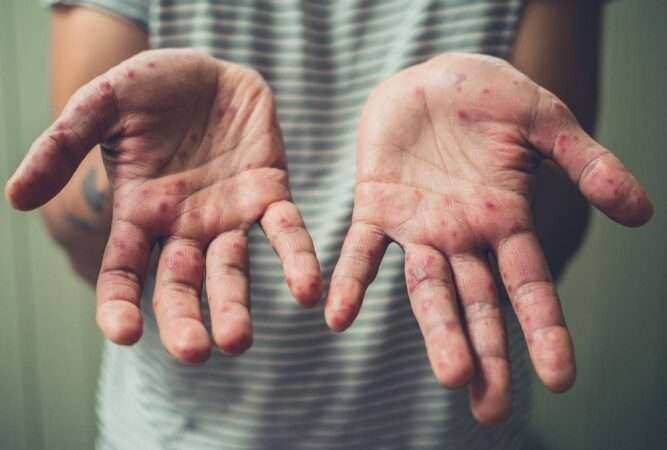 La PBA anuncia el cierre del brote de Sarampión